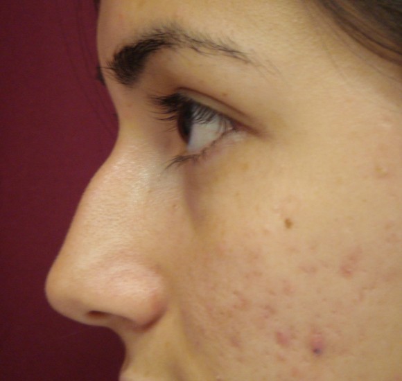 Rhinoplasty Patient Orlando Fl Advanced Aesthetics